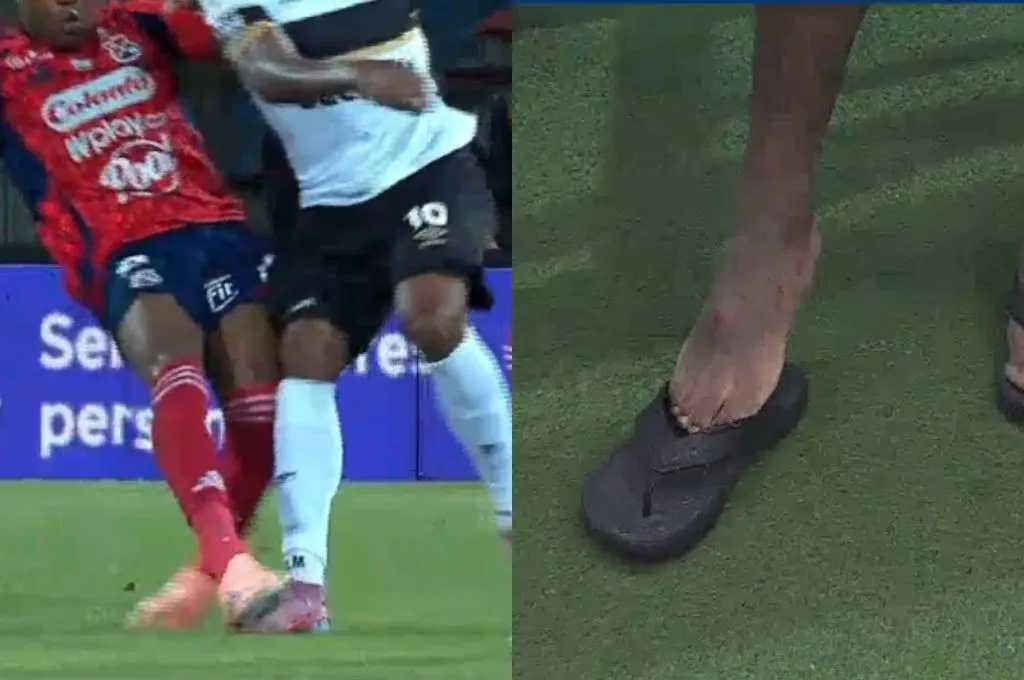 Así quedó el pie de Dereck Moncada tras el pisotón.