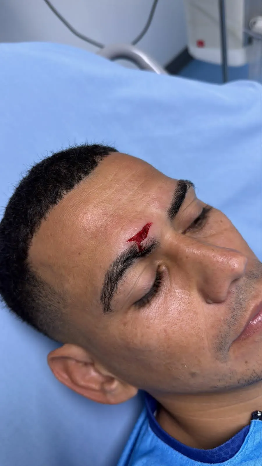 Así quedó el rostro de Edwin Maldonado tras la jugada con “Muma” Fernández en la derrota 1-2 de Choloma. Foto: Cortesía